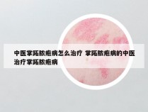 中医掌跖脓疱病怎么治疗 掌跖脓疱病的中医治疗掌跖脓疱病