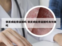 银屑病能敷面膜吗 银屑病能敷面膜吗有效果吗