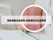 银屑病能吃变蛋吗 银屑病可以吃蛋黄吗