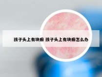 孩子头上有块癣 孩子头上有块癣怎么办