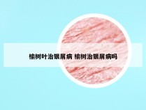 榆树叶治银屑病 榆树治银屑病吗