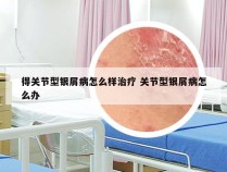 得关节型银屑病怎么样治疗 关节型银屑病怎么办