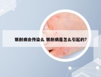 银削病会传染么 银削病是怎么引起的?