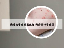 光疗治牛皮癣怎么样 光疗治疗牛皮屑