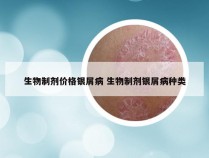 生物制剂价格银屑病 生物制剂银屑病种类