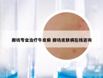 廊坊专业治疗牛皮癣 廊坊皮肤病在线咨询