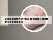 儿童扁桃体肿大得了银屑病 银屑病与扁桃体肥大有直接关系吗