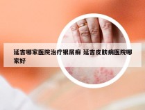 延吉哪家医院治疗银屑癣 延吉皮肤病医院哪家好