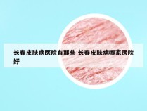 长春皮肤病医院有那些 长春皮肤病哪家医院好