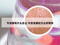 牛皮癣有什么忌口 牛皮皮癣吃什么好得快