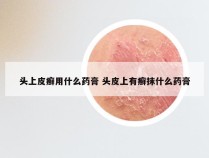 头上皮癣用什么药膏 头皮上有癣抹什么药膏