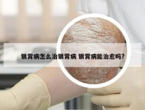 银霄病怎么治银霄病 银霄病能治愈吗?