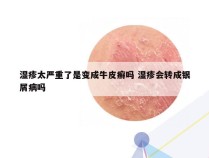 湿疹太严重了是变成牛皮癣吗 湿疹会转成银屑病吗