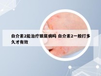 白介素2能治疗银屑病吗 白介素2一般打多久才有效