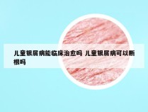 儿童银屑病能临床治愈吗 儿童银屑病可以断根吗