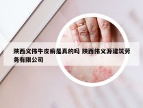 陕西义伟牛皮癣是真的吗 陕西伟义源建筑劳务有限公司