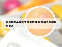 银屑病是寻麻疹发展来的吗 银屑病与荨麻疹的关系