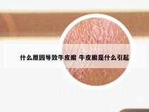 什么原因导致牛皮廨 牛皮廨是什么引起