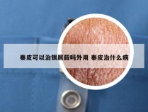 秦皮可以治银屑藓吗外用 秦皮治什么病