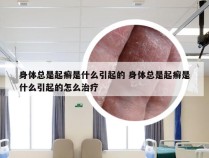 身体总是起癣是什么引起的 身体总是起癣是什么引起的怎么治疗