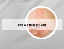 藓怎么去根 癣怎么去根