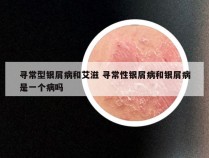 寻常型银屑病和艾滋 寻常性银屑病和银屑病是一个病吗