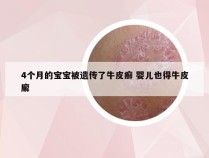 4个月的宝宝被遗传了牛皮癣 婴儿也得牛皮廨