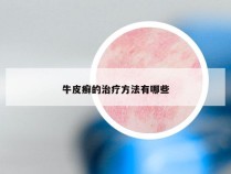 牛皮癣的治疗方法有哪些