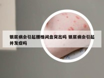 银屑病会引起腰椎间盘突出吗 银屑病会引起并发症吗