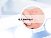 牛皮癣100治疗