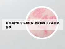 银屑病吃什么水果好呢 银屑病吃什么水果好得快