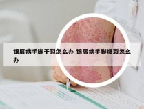 银屑病手脚干裂怎么办 银屑病手脚爆裂怎么办