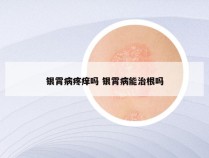 银霄病疼痒吗 银霄病能治根吗