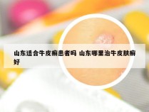 山东适合牛皮癣患者吗 山东哪里治牛皮肤癣好