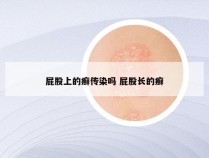 屁股上的癣传染吗 屁股长的癣