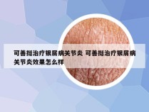 可善挺治疗银屑病关节炎 可善挺治疗银屑病关节炎效果怎么样