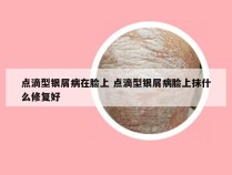 点滴型银屑病在脸上 点滴型银屑病脸上抹什么修复好