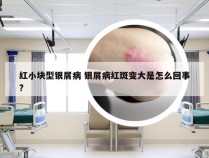 红小块型银屑病 银屑病红斑变大是怎么回事?