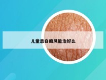 儿童患白癜风能治好么