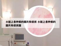 小腿上各种癣的图片和症状 小腿上各种癣的图片和症状图