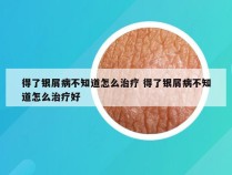 得了银屑病不知道怎么治疗 得了银屑病不知道怎么治疗好