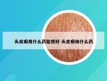 头皮癣用什么药能擦好 头皮癣抹什么药