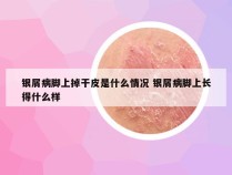 银屑病脚上掉干皮是什么情况 银屑病脚上长得什么样