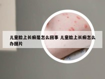 儿童脸上长癣是怎么回事 儿童脸上长癣怎么办图片