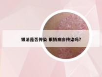 银消是否传染 银销病会传染吗?