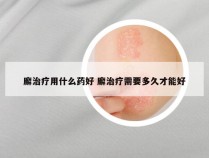 廨治疗用什么药好 廨治疗需要多久才能好