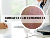 银屑病会从头皮蔓延嘛 银屑病会出现在头上吗