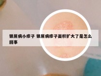 银屑病小疹子 银屑病疹子面积扩大了是怎么回事