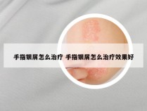 手指银屑怎么治疗 手指银屑怎么治疗效果好