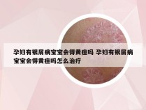 孕妇有银屑病宝宝会得黄疸吗 孕妇有银屑病宝宝会得黄疸吗怎么治疗